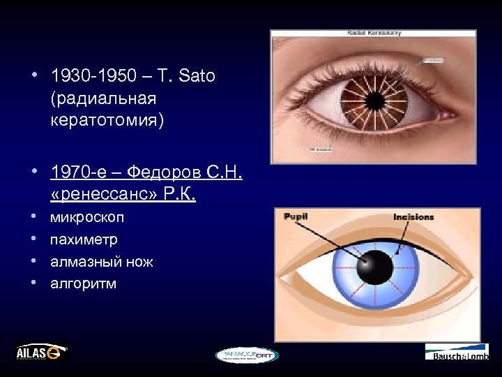  • 1930 -1950 – Т. Sato (радиальная кератотомия) • 1970 -е – Федоров