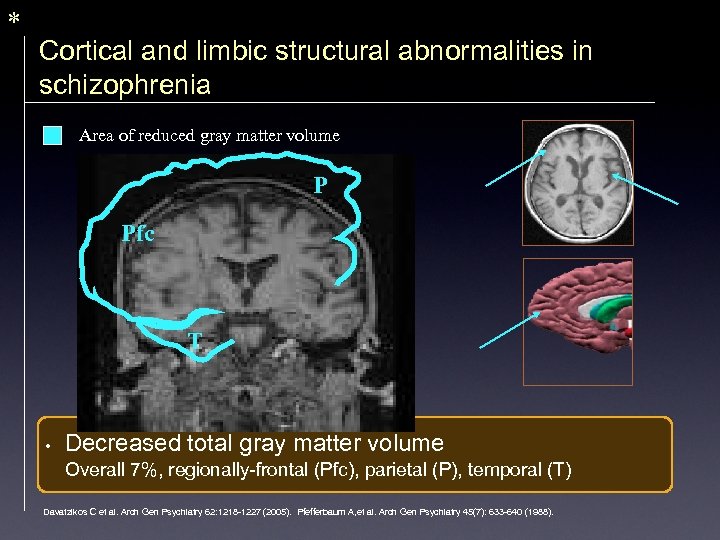 * Cortical and limbic structural abnormalities in schizophrenia Area of reduced gray matter volume