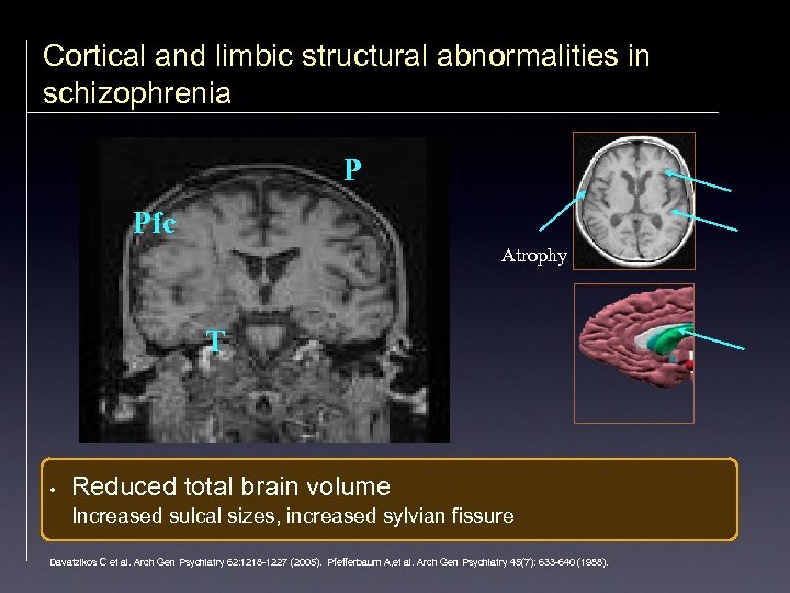 Cortical and limbic structural abnormalities in schizophrenia P Pfc Atrophy T • Reduced total