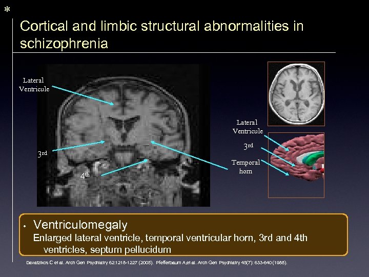 * Cortical and limbic structural abnormalities in schizophrenia Lateral Ventricule 3 rd 4 th