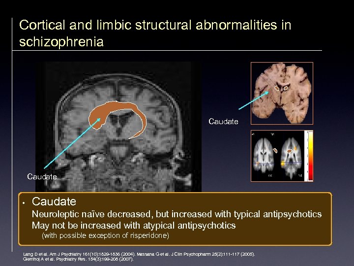 Cortical and limbic structural abnormalities in schizophrenia Caudate • Caudate Neuroleptic naïve decreased, but