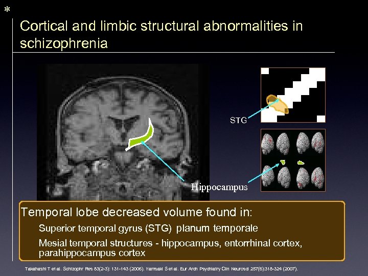 * Cortical and limbic structural abnormalities in schizophrenia STG Hippocampus Temporal lobe decreased volume
