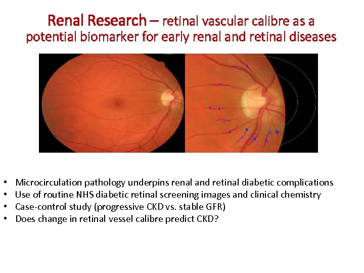 Renal Research – retinal vascular calibre as a potential biomarker for early renal and