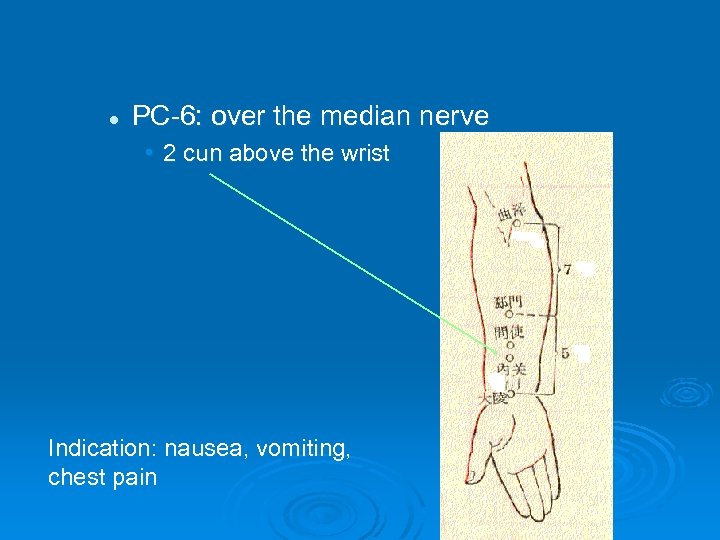 l PC-6: over the median nerve • 2 cun above the wrist Indication: nausea,