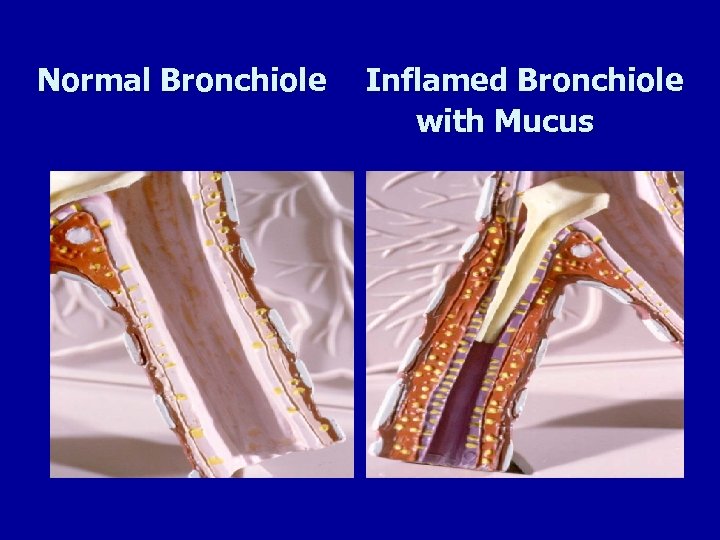 Normal Bronchiole Inflamed Bronchiole with Mucus 