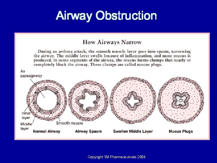 Airway Obstruction Copyright 3 M Pharmaceuticals 2004 