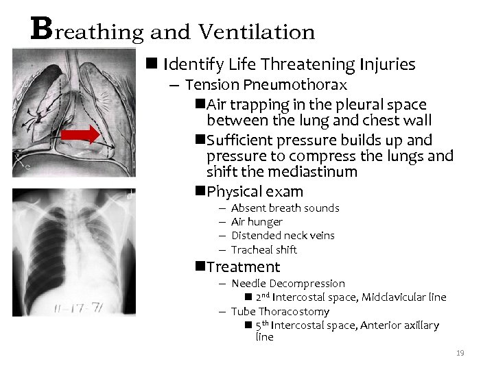 Breathing and Ventilation n Identify Life Threatening Injuries – Tension Pneumothorax n. Air trapping