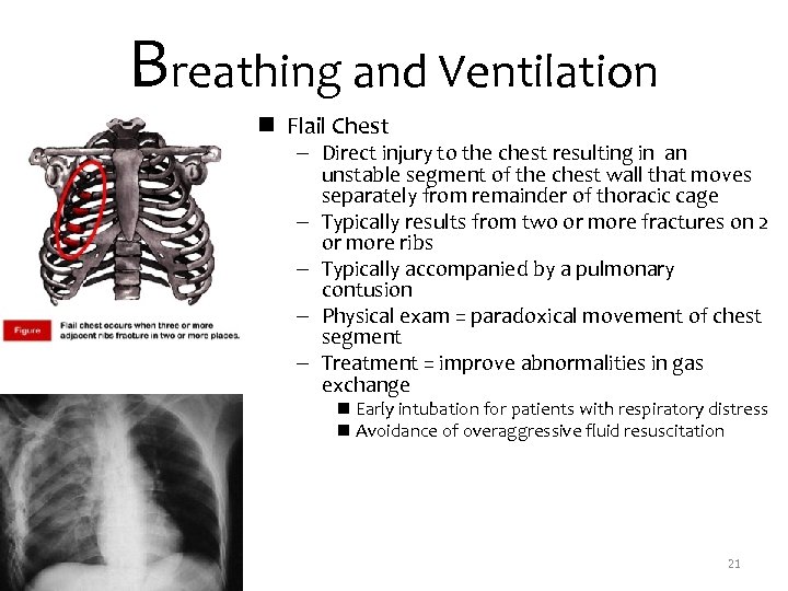 Breathing and Ventilation n Flail Chest – Direct injury to the chest resulting in