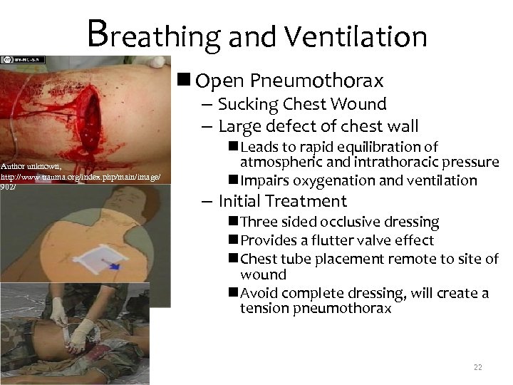 Breathing and Ventilation n Open Pneumothorax – Sucking Chest Wound – Large defect of