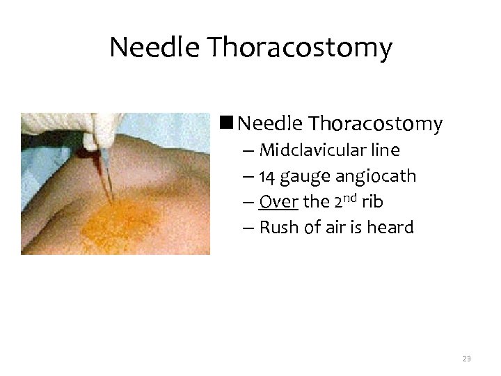 Needle Thoracostomy n Needle Thoracostomy – Midclavicular line – 14 gauge angiocath – Over