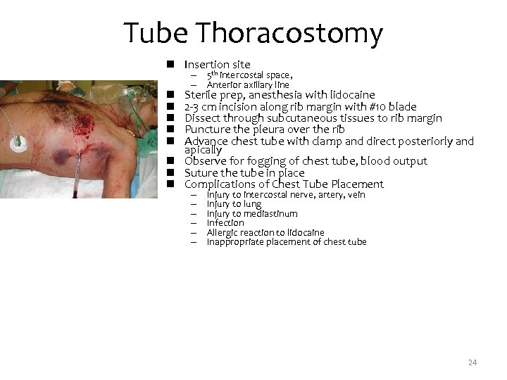 Tube Thoracostomy n Insertion site – 5 th intercostal space, – Anterior axillary line