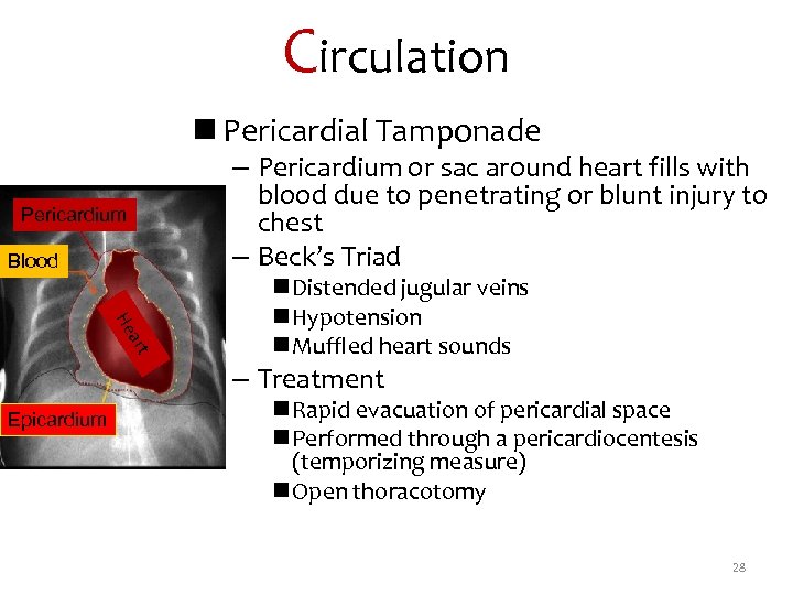 Circulation n Pericardial Tamponade Pericardium Blood – Pericardium or sac around heart fills with