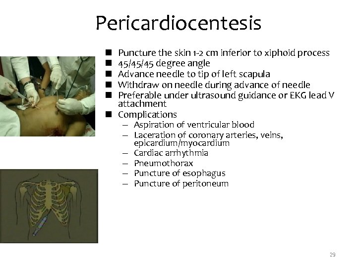 Pericardiocentesis Puncture the skin 1 -2 cm inferior to xiphoid process 45/45/45 degree angle