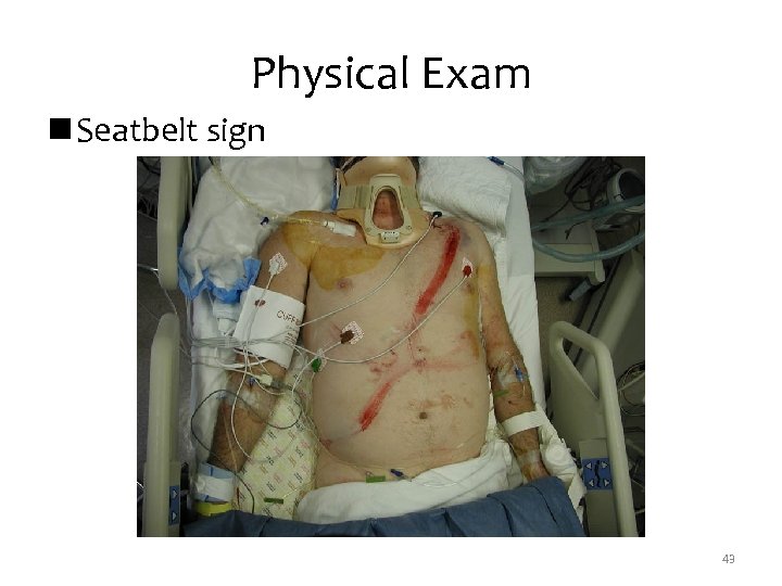 Physical Exam n Seatbelt sign 43 