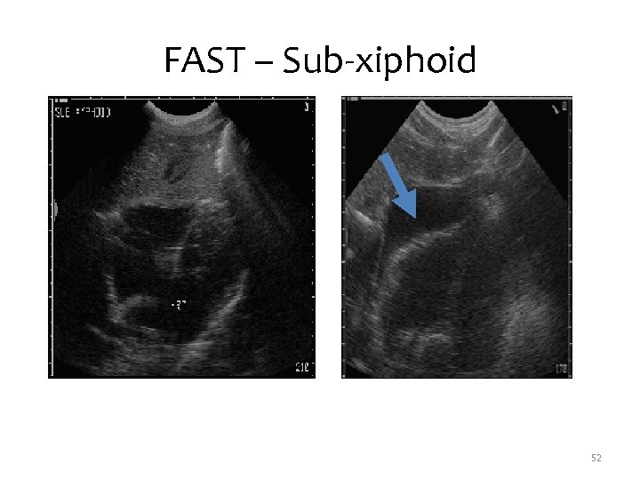 FAST – Sub-xiphoid 52 