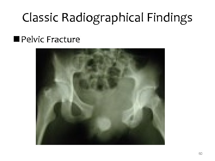 Classic Radiographical Findings n Pelvic Fracture 60 