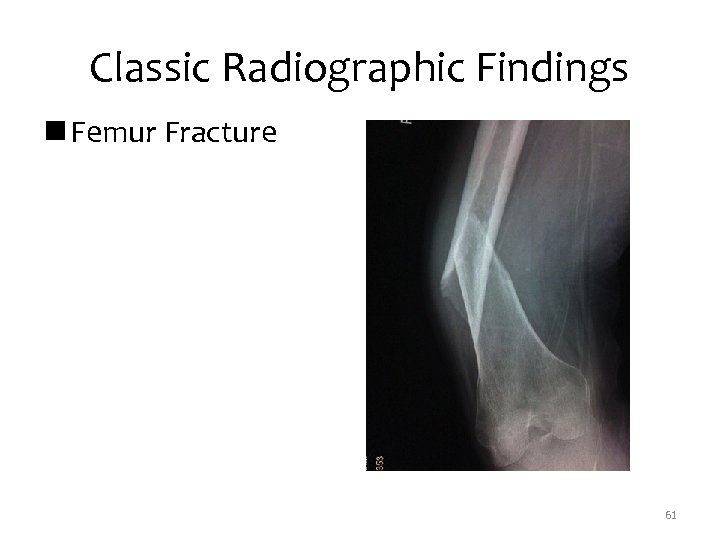 Classic Radiographic Findings n Femur Fracture 61 