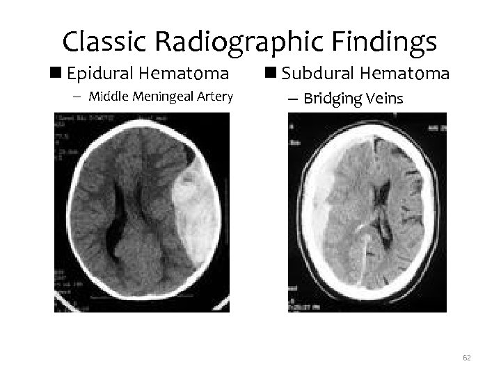 Classic Radiographic Findings n Epidural Hematoma – Middle Meningeal Artery n Subdural Hematoma –