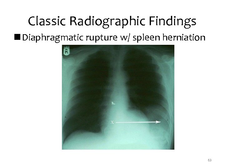Classic Radiographic Findings n Diaphragmatic rupture w/ spleen herniation 63 