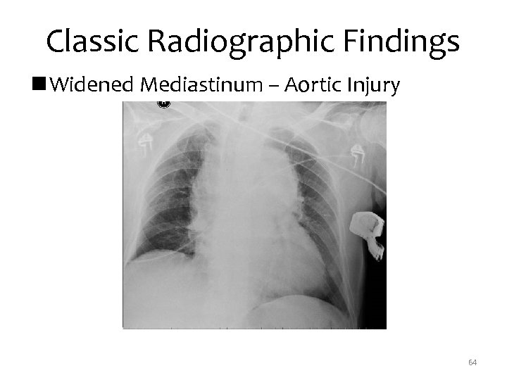 Classic Radiographic Findings n Widened Mediastinum – Aortic Injury 64 
