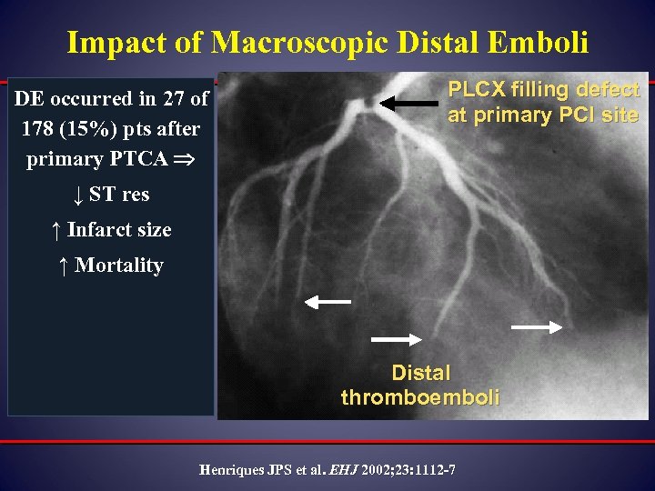 Impact of Macroscopic Distal Emboli DE occurred in 27 of 178 (15%) pts after