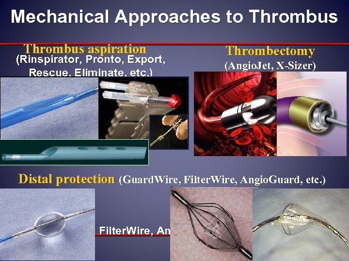 Mechanical Approaches to Thrombus aspiration (Rinspirator, Pronto, Export, Rescue, Eliminate, etc. ) Thrombectomy (Angio.