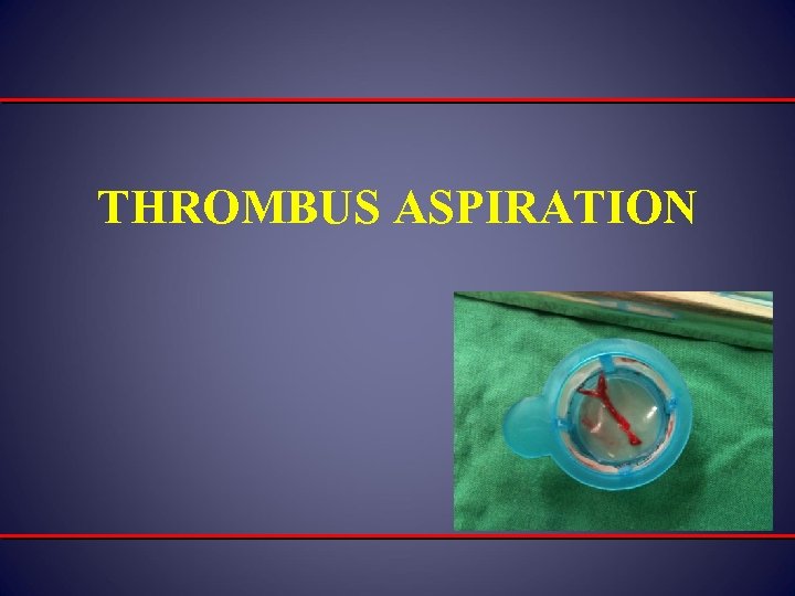 THROMBUS ASPIRATION 