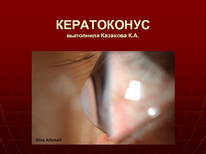 КЕРАТОКОНУС выполнила Казакова К. А. 