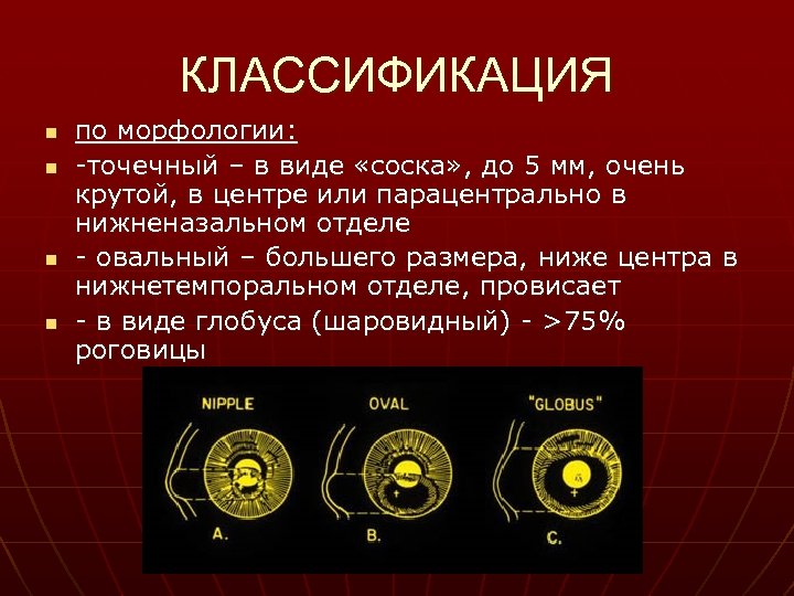 КЛАССИФИКАЦИЯ n n по морфологии: -точечный – в виде «соска» , до 5 мм,