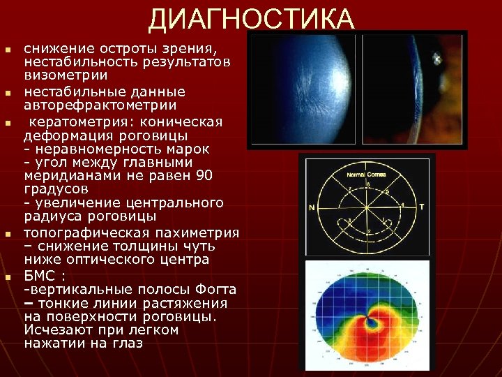 ДИАГНОСТИКА n n n снижение остроты зрения, нестабильность результатов визометрии нестабильные данные авторефрактометрии кератометрия: