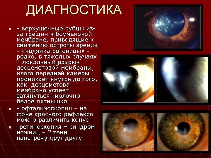 ДИАГНОСТИКА n n n - верхушечные рубцы изза трещин в боуменовой мембране, приводящие к