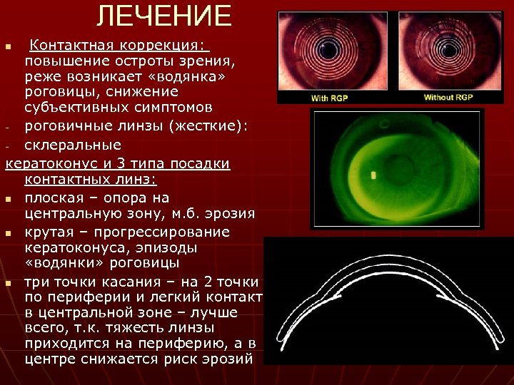 ЛЕЧЕНИЕ Контактная коррекция: повышение остроты зрения, реже возникает «водянка» роговицы, снижение субъективных симптомов роговичные