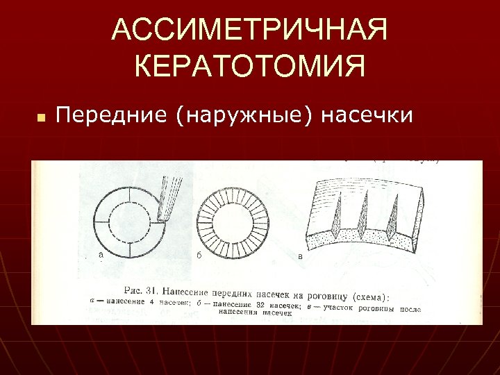 АССИМЕТРИЧНАЯ КЕРАТОТОМИЯ n Передние (наружные) насечки 