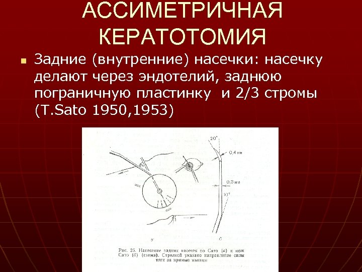 АССИМЕТРИЧНАЯ КЕРАТОТОМИЯ n Задние (внутренние) насечки: насечку делают через эндотелий, заднюю пограничную пластинку и
