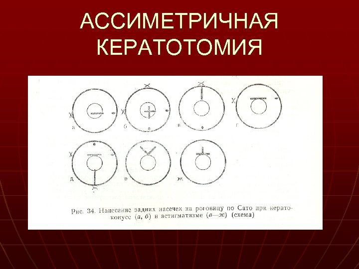 АССИМЕТРИЧНАЯ КЕРАТОТОМИЯ 