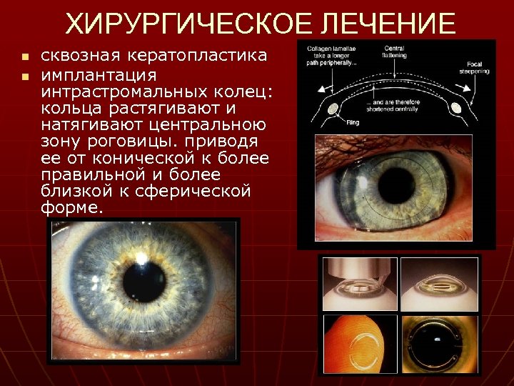 ХИРУРГИЧЕСКОЕ ЛЕЧЕНИЕ n n сквозная кератопластика имплантация интрастромальных колец: кольца растягивают и натягивают центральною
