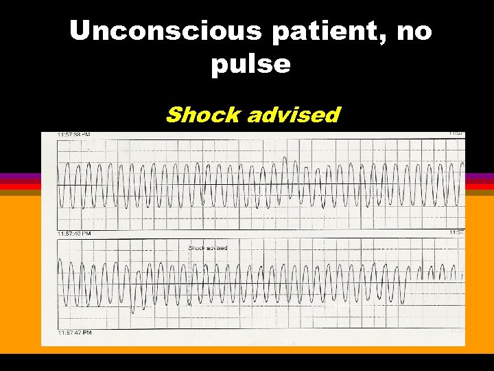 Unconscious patient, no pulse Shock advised 