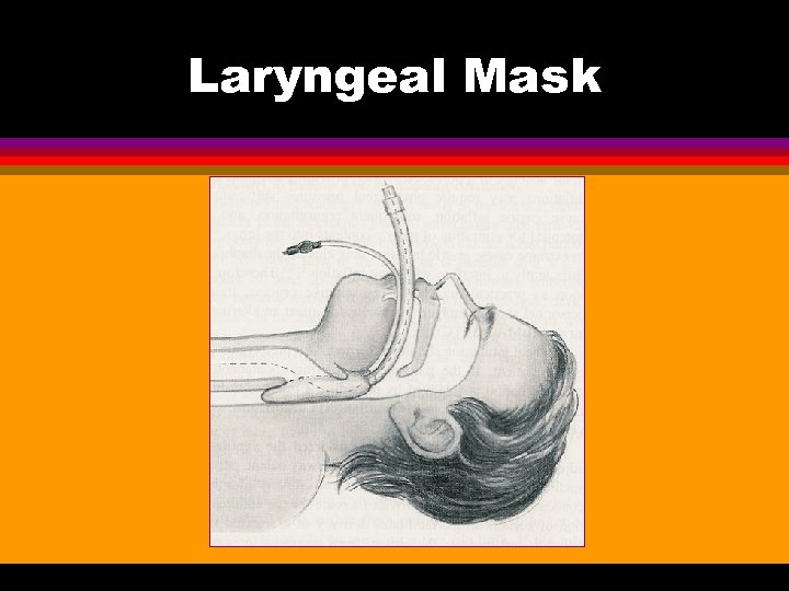 Laryngeal Mask 