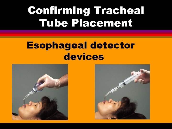Confirming Tracheal Tube Placement Esophageal detector devices 