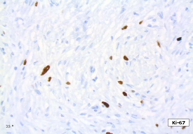 35 * Ki-67 