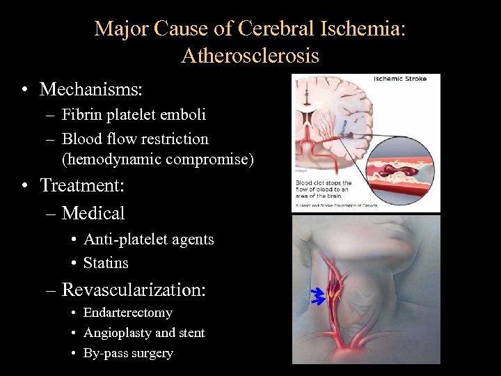 Major Cause of Cerebral Ischemia: Atherosclerosis • Mechanisms: – Fibrin platelet emboli – Blood