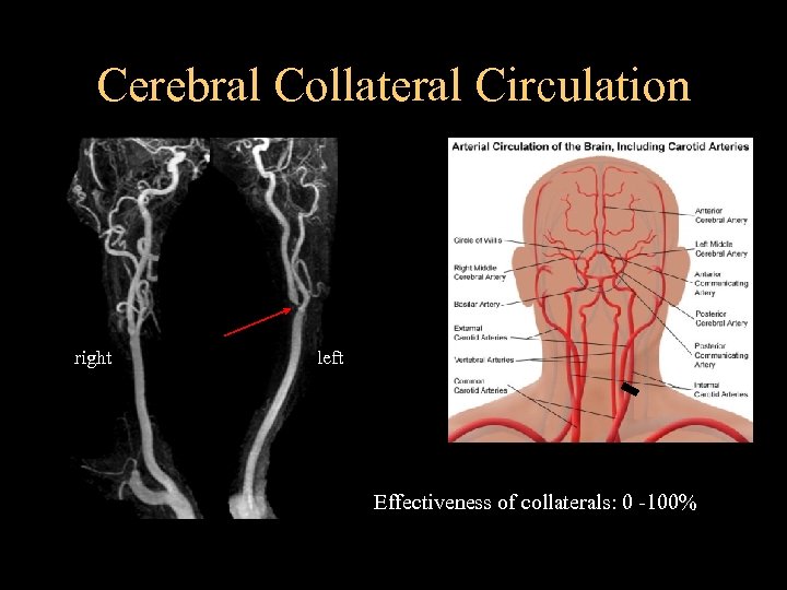 Cerebral Collateral Circulation right left Effectiveness of collaterals: 0 -100% 