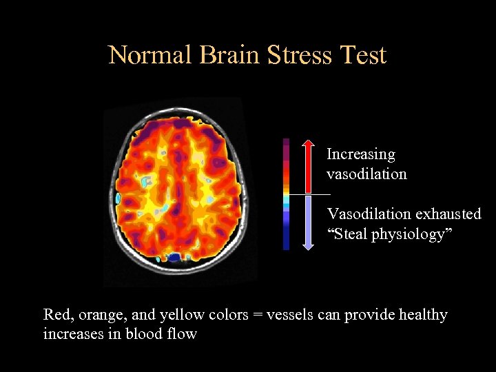 Normal Brain Stress Test Increasing vasodilation Vasodilation exhausted “Steal physiology” Red, orange, and yellow