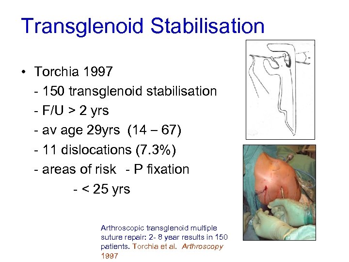 Transglenoid Stabilisation • Torchia 1997 - 150 transglenoid stabilisation - F/U > 2 yrs