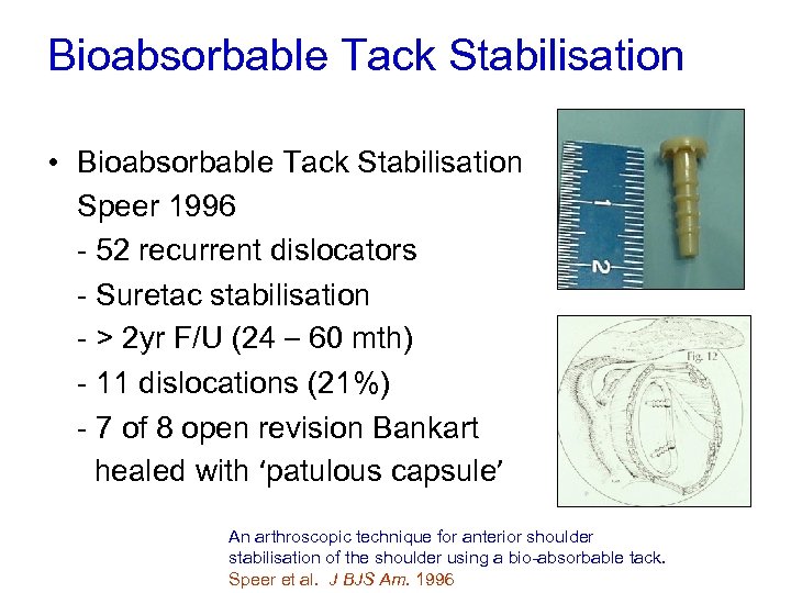 Bioabsorbable Tack Stabilisation • Bioabsorbable Tack Stabilisation Speer 1996 - 52 recurrent dislocators -