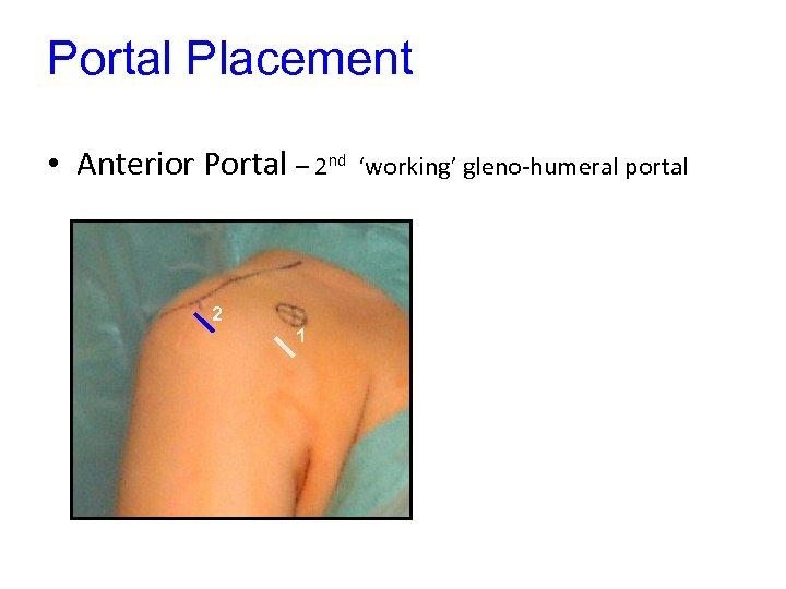 Portal Placement • Anterior Portal – 2 nd 2 1 ‘working’ gleno-humeral portal 