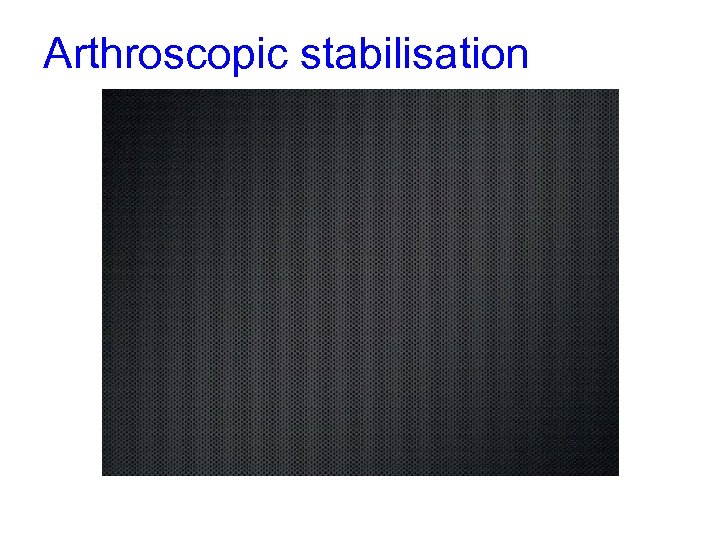 Arthroscopic stabilisation 