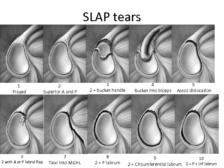 SLAP tears 1 Frayed 6 2 with A or P labral flap 2 Superior