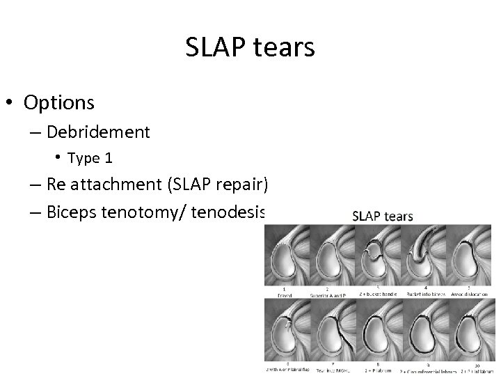 SLAP tears • Options – Debridement • Type 1 – Re attachment (SLAP repair)