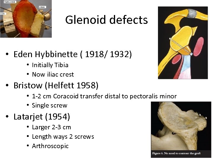 Glenoid defects • Eden Hybbinette ( 1918/ 1932) • Initially Tibia • Now iliac